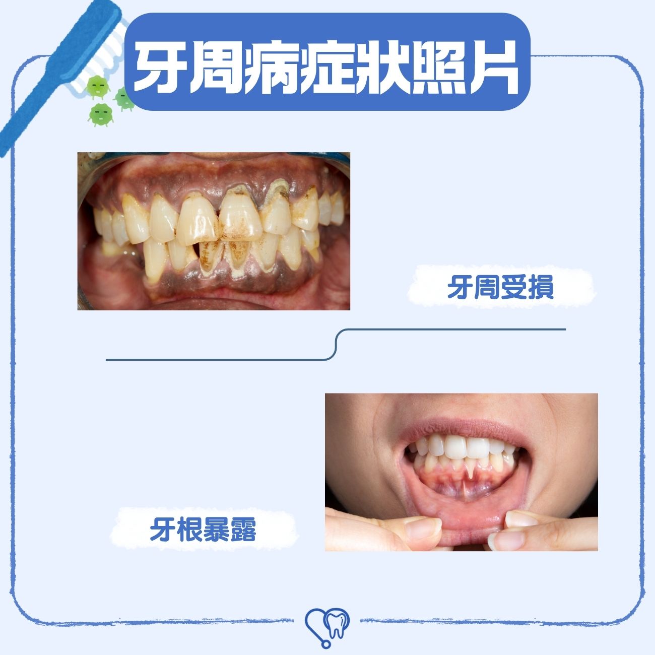 牙周病症狀照片