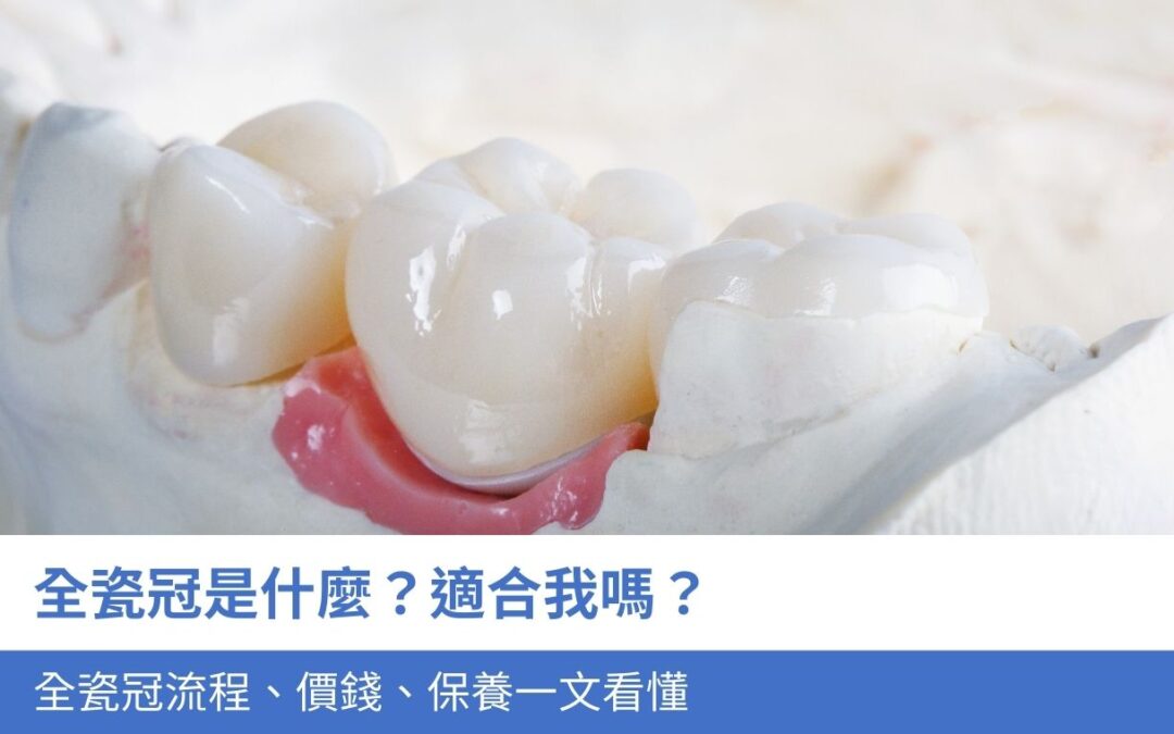 全瓷冠是什麼？適合我嗎？全瓷冠5大流程、價錢、保養一文看懂