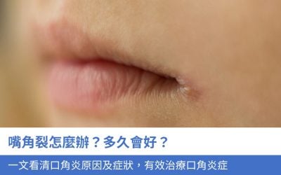 嘴角裂怎麼辦？多久會好？一文看清口角炎原因及症狀，學會3招有效治療口角炎症