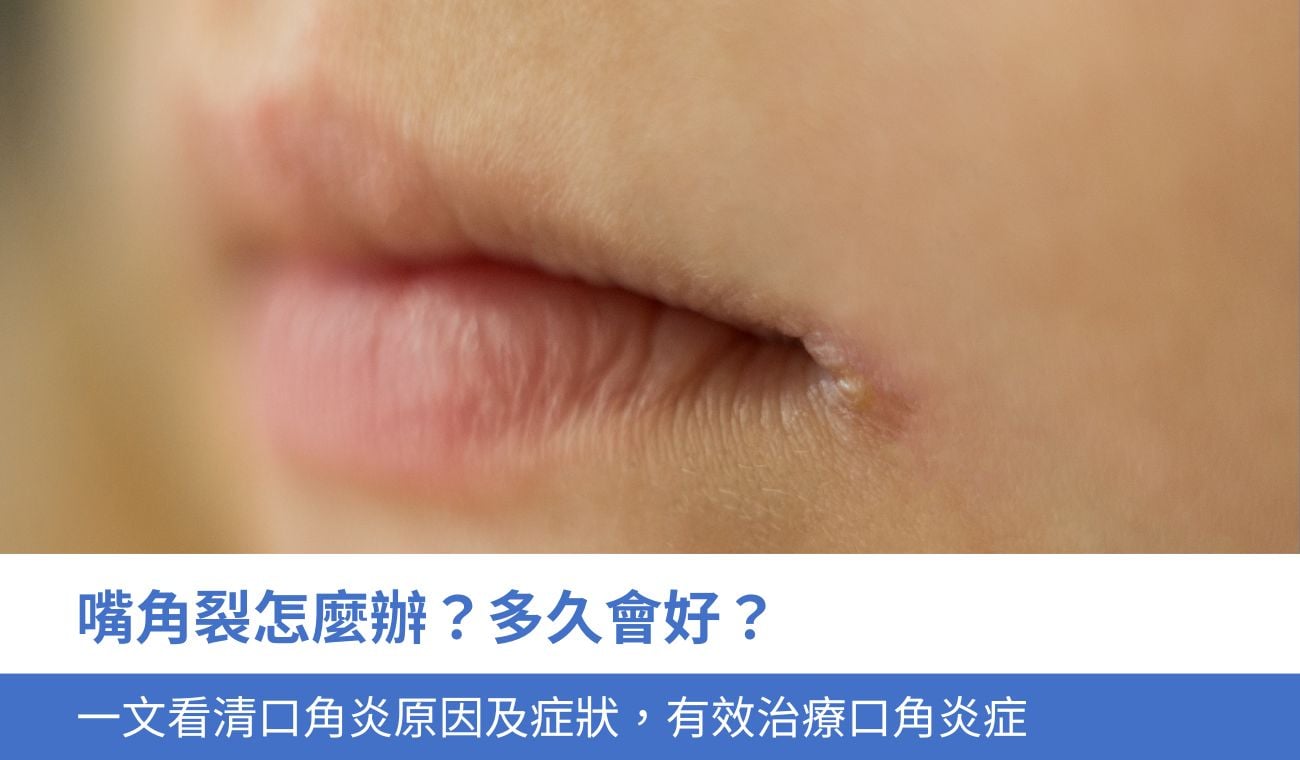 口角炎怎麼辦？