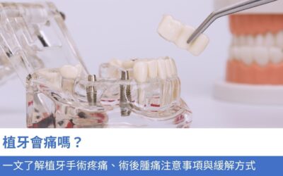 牙科知識庫 11 植牙會痛嗎?一文了解植牙手術 疼痛、術後腫痛注意事項與緩解方式