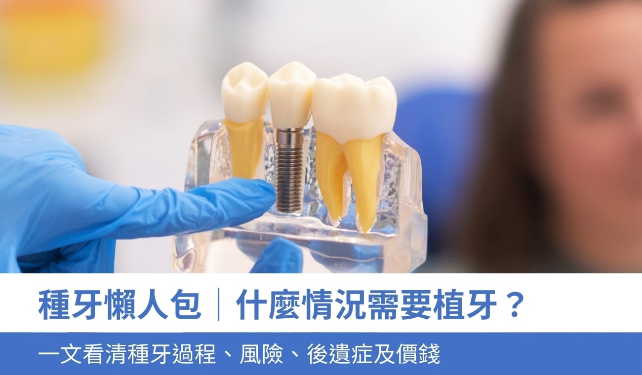種牙懶人包
