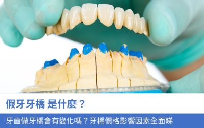 假牙牙橋是什麼？牙齒做牙橋會有變化嗎？3大牙橋價格影響因素全面睇