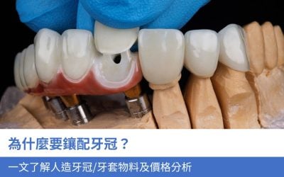 為什麼要鑲配牙冠？一文了解3大人造牙冠/牙套物料及價格分析