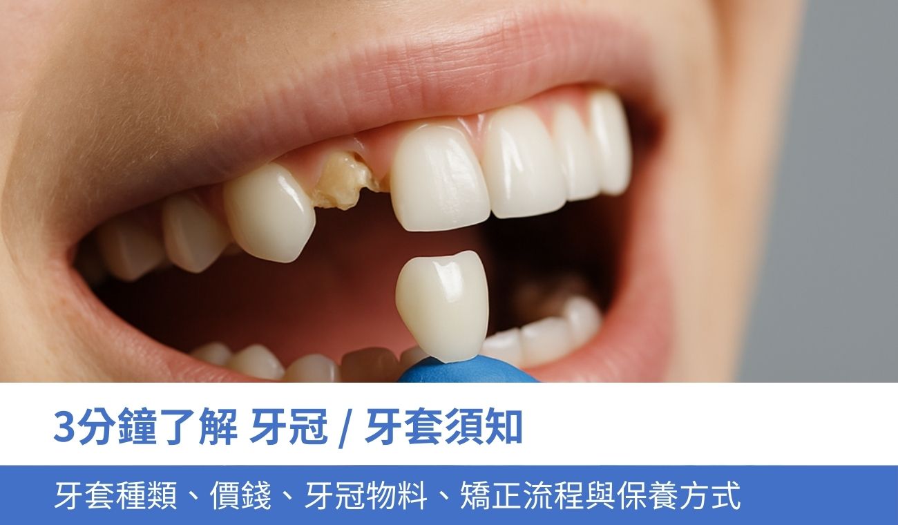 3分鐘了解牙冠/ 牙套須知：牙套種類、牙套價錢、物料