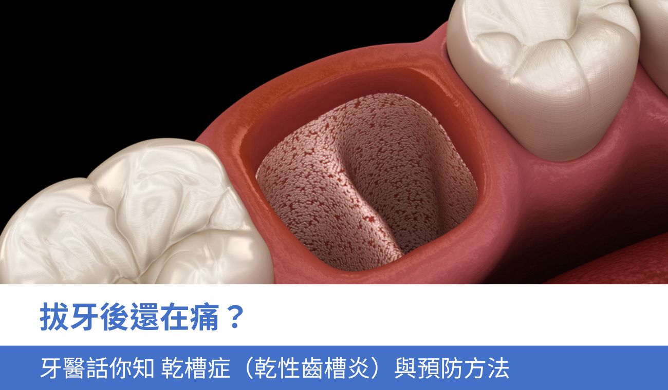 乾槽症（乾性齒槽炎）