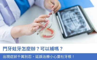 門牙蛀牙怎麼辦？可以補嗎？出現7大症狀千萬別忍，延誤治療小心要杜牙根！