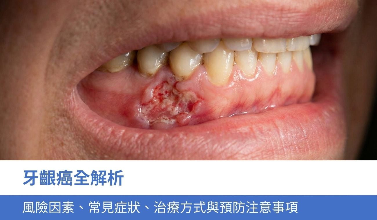 gingival-cancer 牙齦癌全解析:風險因素、常見症狀、治療方式與預防注意事項