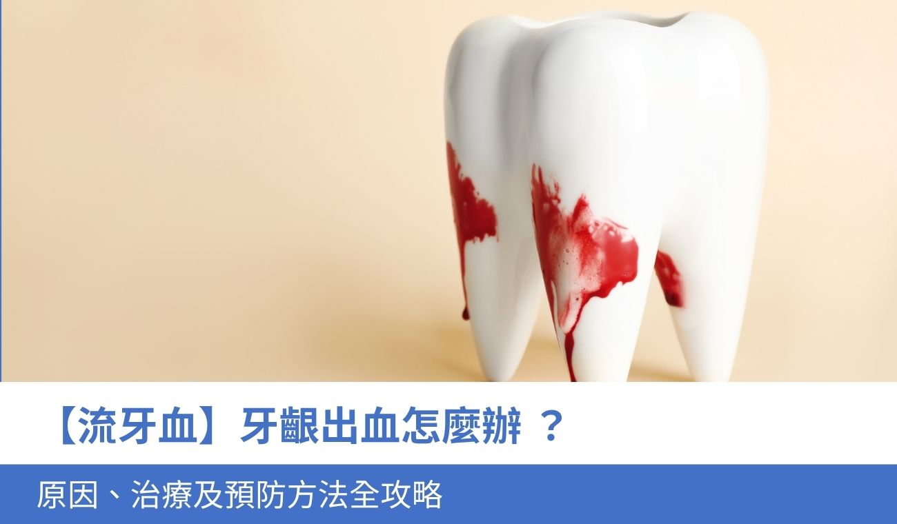 gum-bleeding-complete-guide 刷牙流牙血怎麼辦?5大 牙齦出血原因、治療及預防方法全攻略