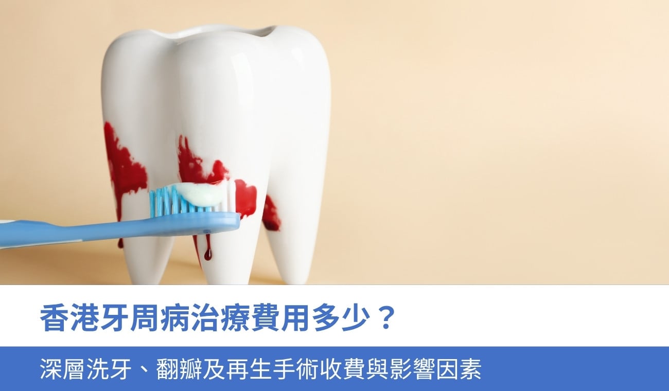 香港牙周病治療費用多少？深層洗牙、翻瓣及再生手術收費與 4 個影響因素