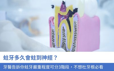 蛀牙多久會蛀到神經？牙醫告訴你蛀牙嚴重程度可分3階段，不想杜牙根必看