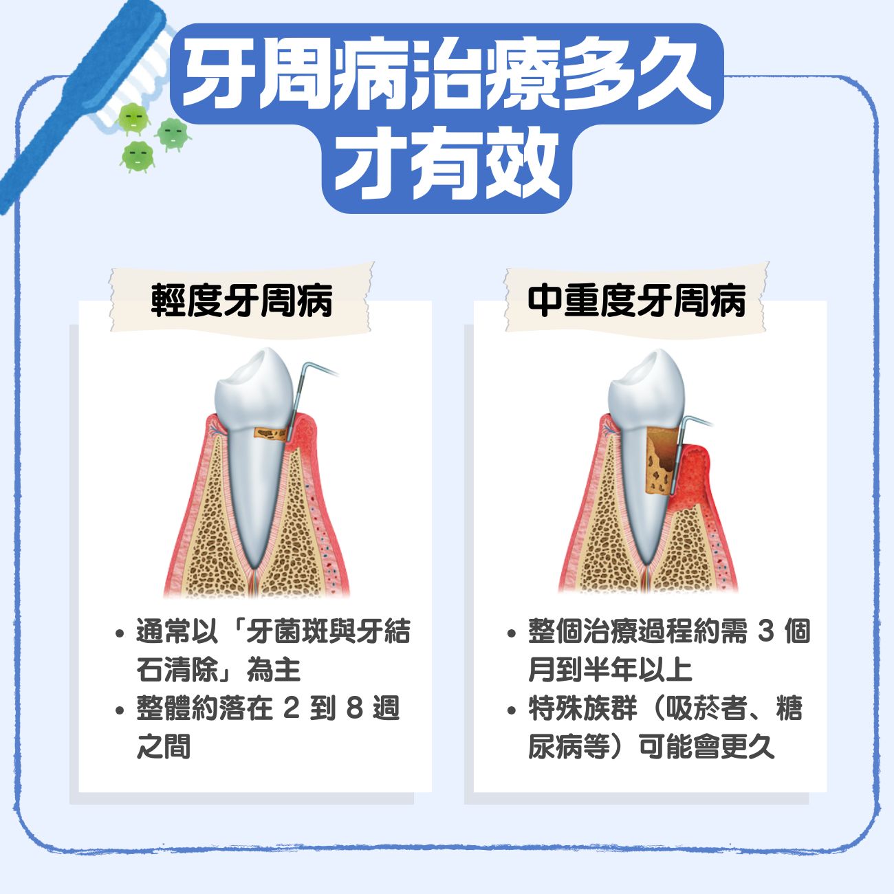 牙周病治療多久才有效?從輕度到重度:3 階段治療時間一文看清 2 牙周病治療多久才有效?