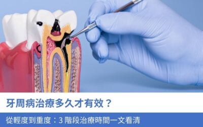 牙周病治療多久才有效?從輕度到重度:3 階段治療時間一文看清