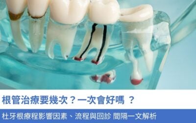 牙科知識庫 6 根管治療要幾次?一次會好嗎 ?3大杜牙根療程影響因素、流程與回診 間隔一文解析