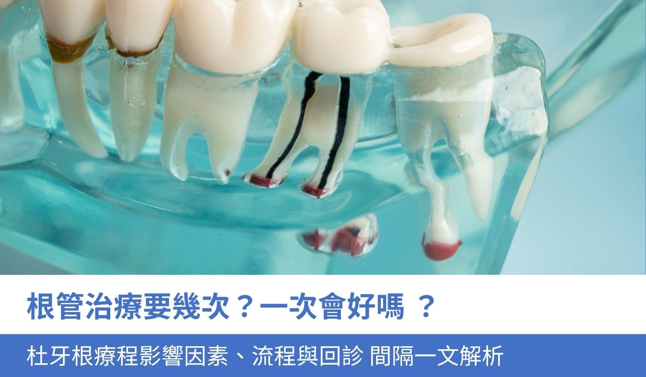 根管治療要幾次？3大杜牙根療程影響因素與回診 間隔時間一文看清