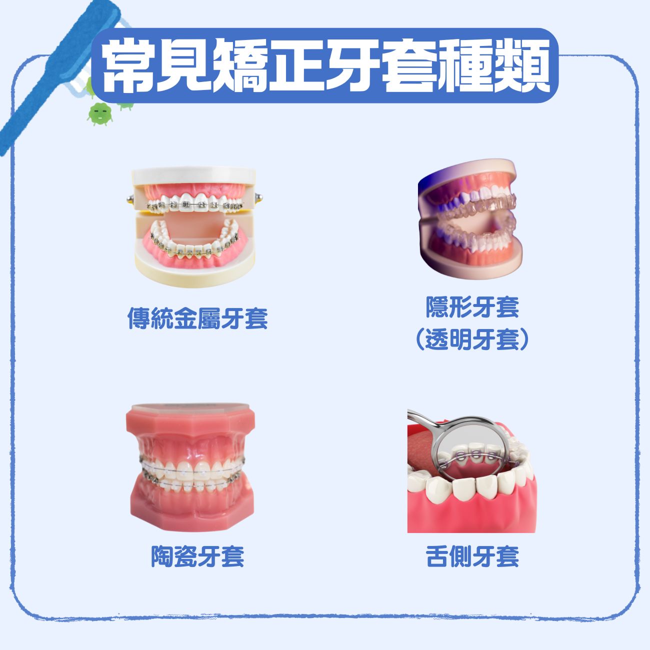 箍牙 牙套 怎麼選?4大 牙齒 矯正器種類、流程、牙套價格 一文看清 4 常見矯正牙套種類