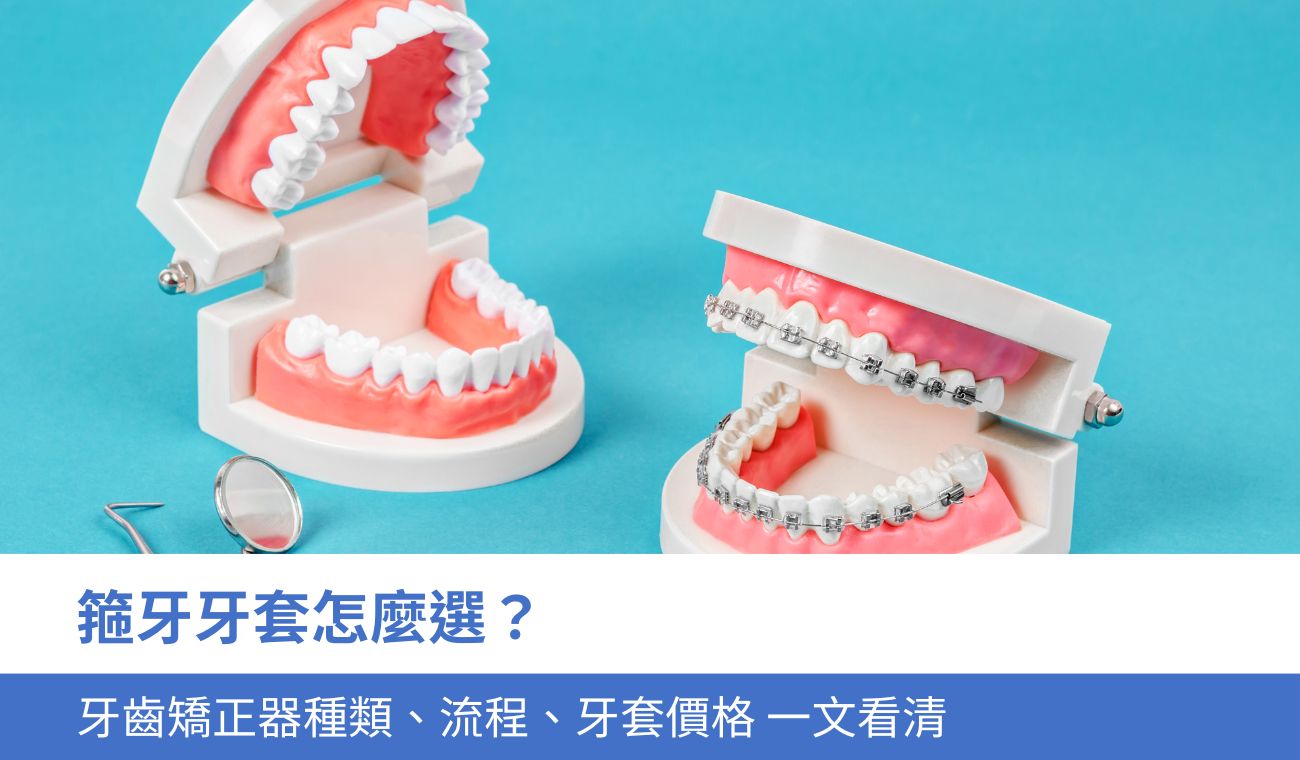 箍牙 牙套怎麼選？4大牙齒矯正器種類優缺點、矯正流程及價錢一文看清