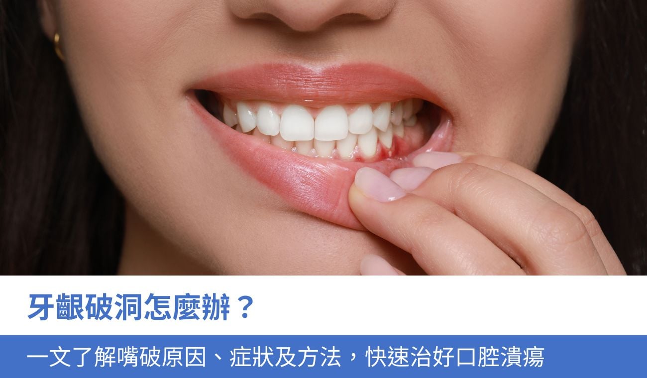 牙齦破洞怎麼辦？一文了解5大嘴破原因、症狀及方法，快速治好口腔潰瘍