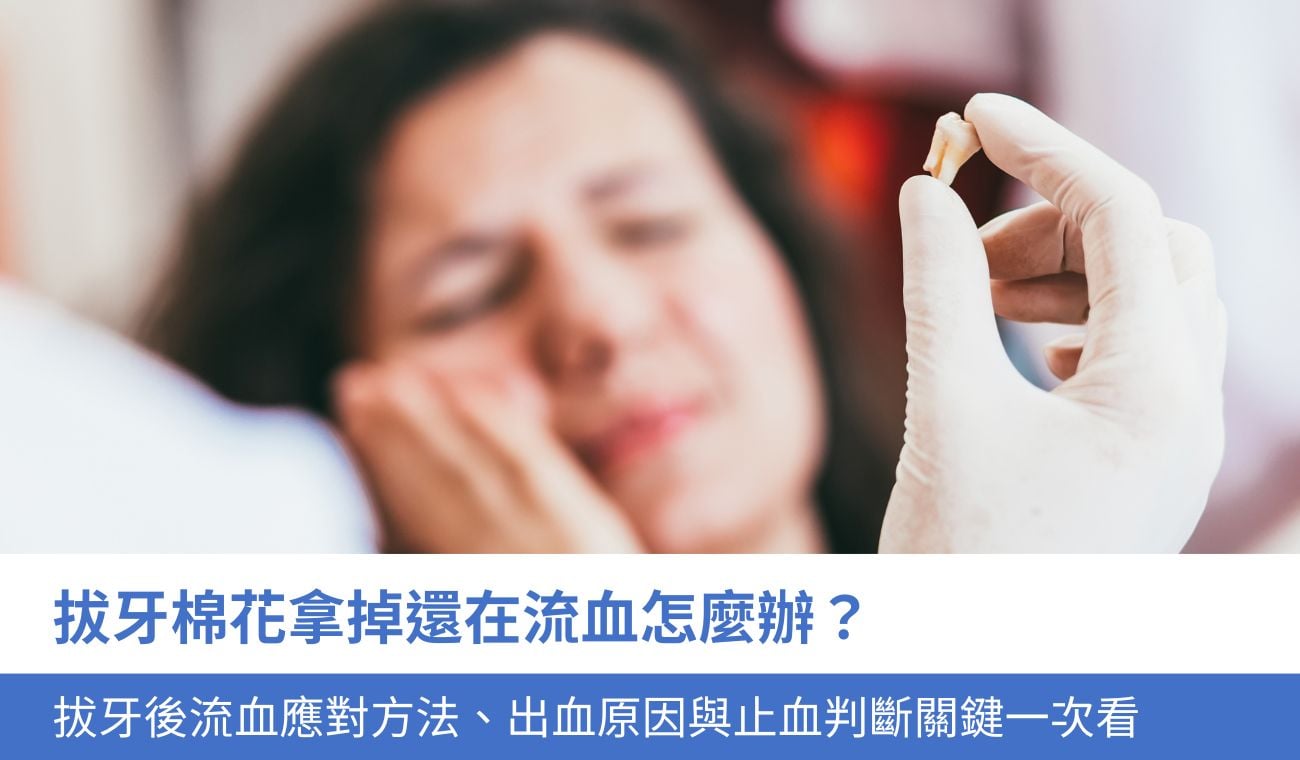 拔牙棉花拿掉還在流血怎麼辦？5大拔牙後出血應對方法、止血判斷關鍵一次看