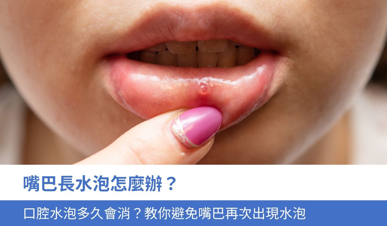 口腔水泡多久會消？