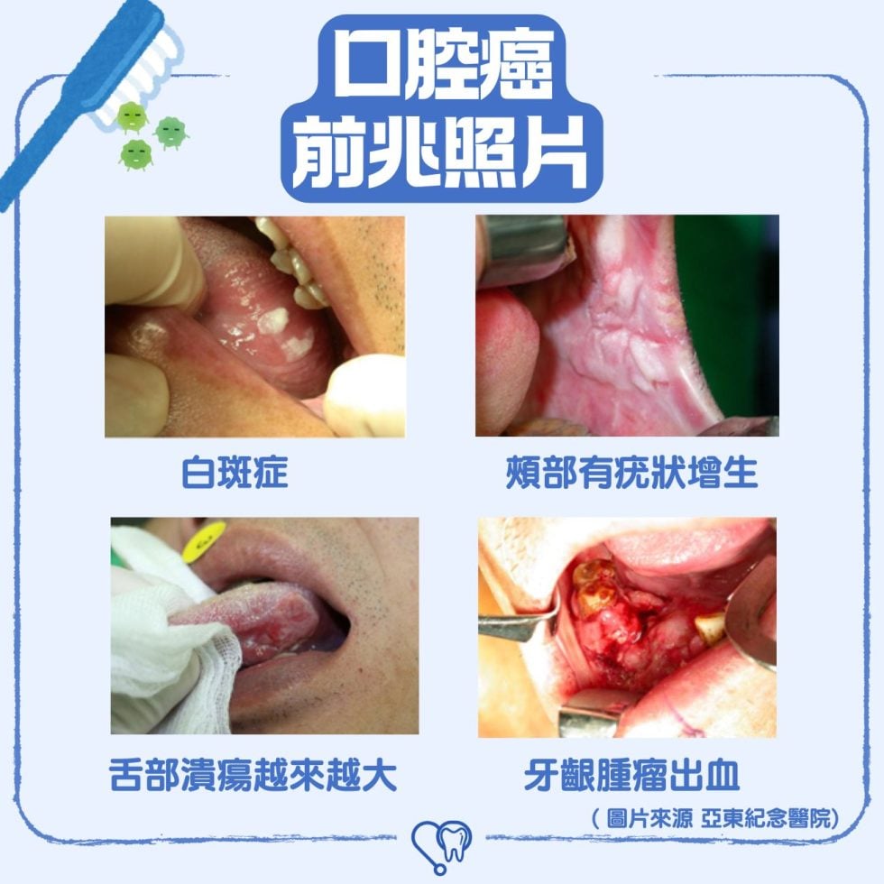【預防 口腔癌 】口腔癌初期症狀有哪些? 5大預防方法和 口腔 癌症治療方式一文看清