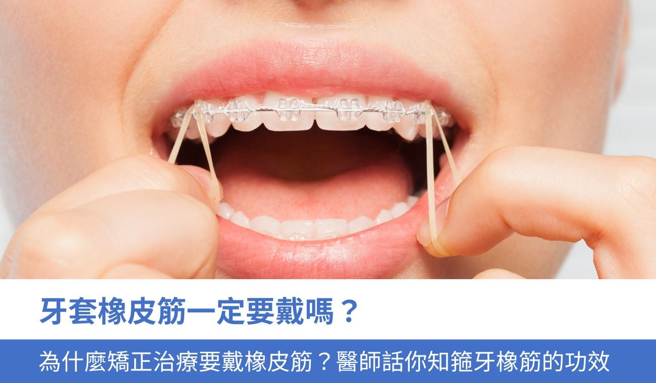 牙套橡皮筋一定要戴嗎?