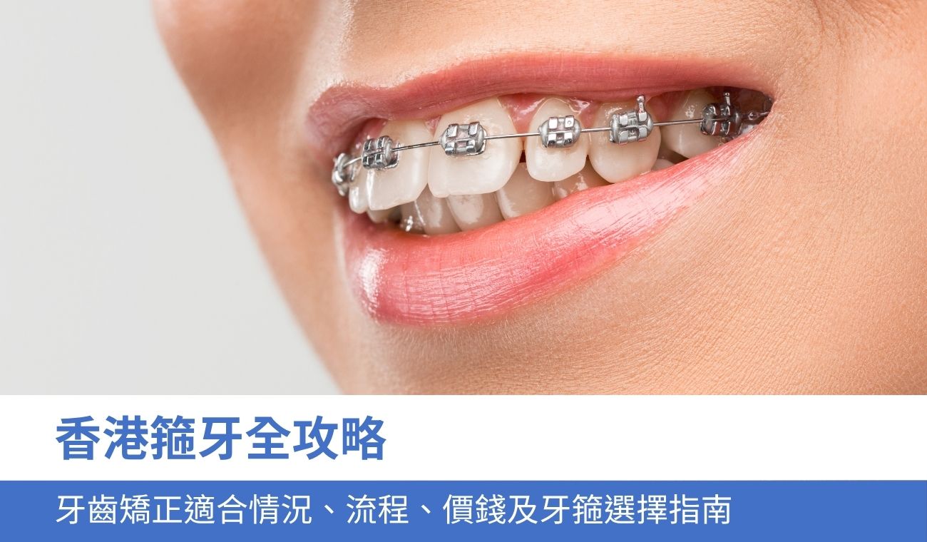 香港箍牙全攻略:牙齒矯正 適合情況、流程、價錢及4大牙箍選擇指南