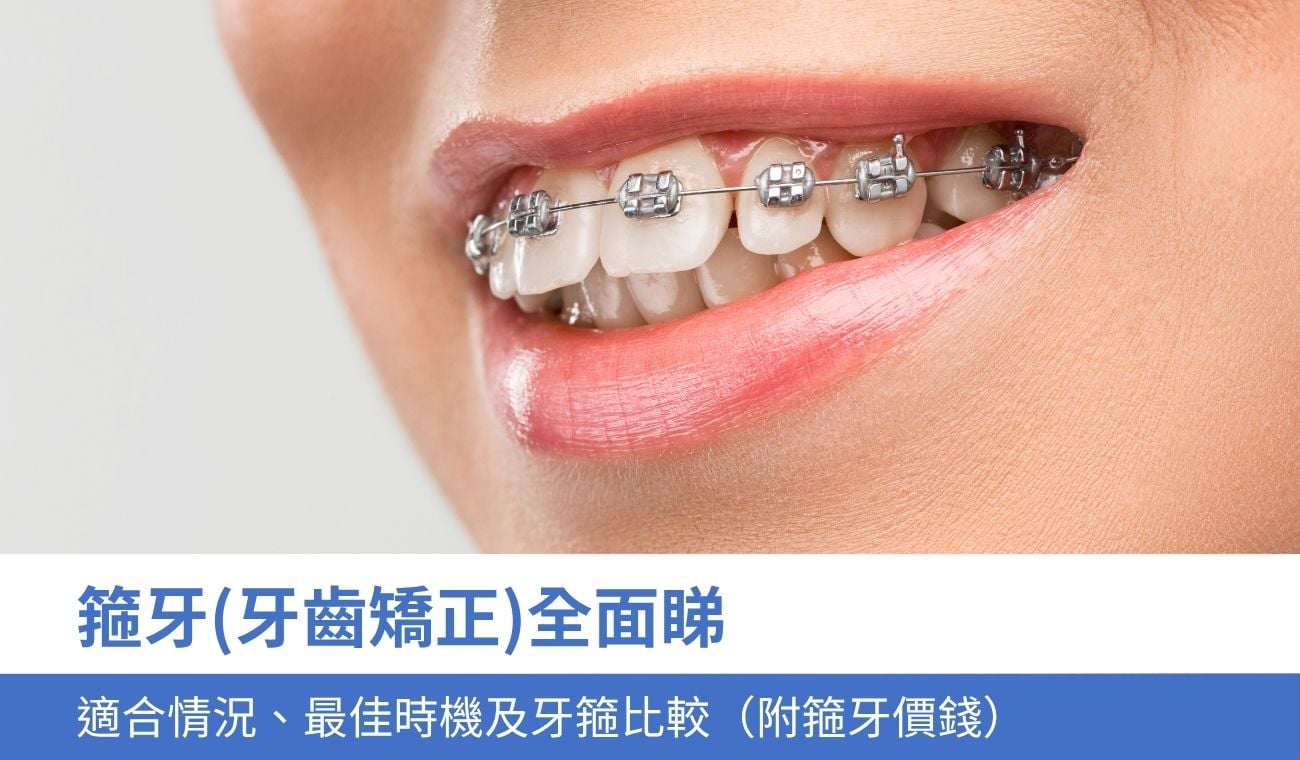 箍牙(牙齒矯正)全面睇