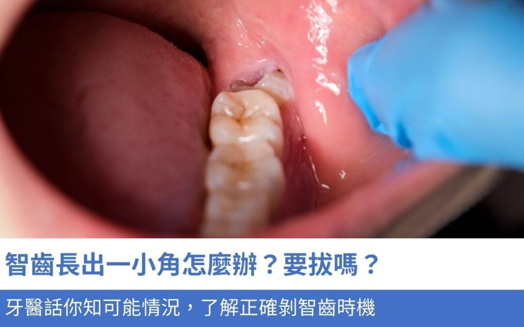 智齒長出一小角 怎麼辦？要拔嗎？牙醫話你知4種可能情況，了解正確剝智齒時機