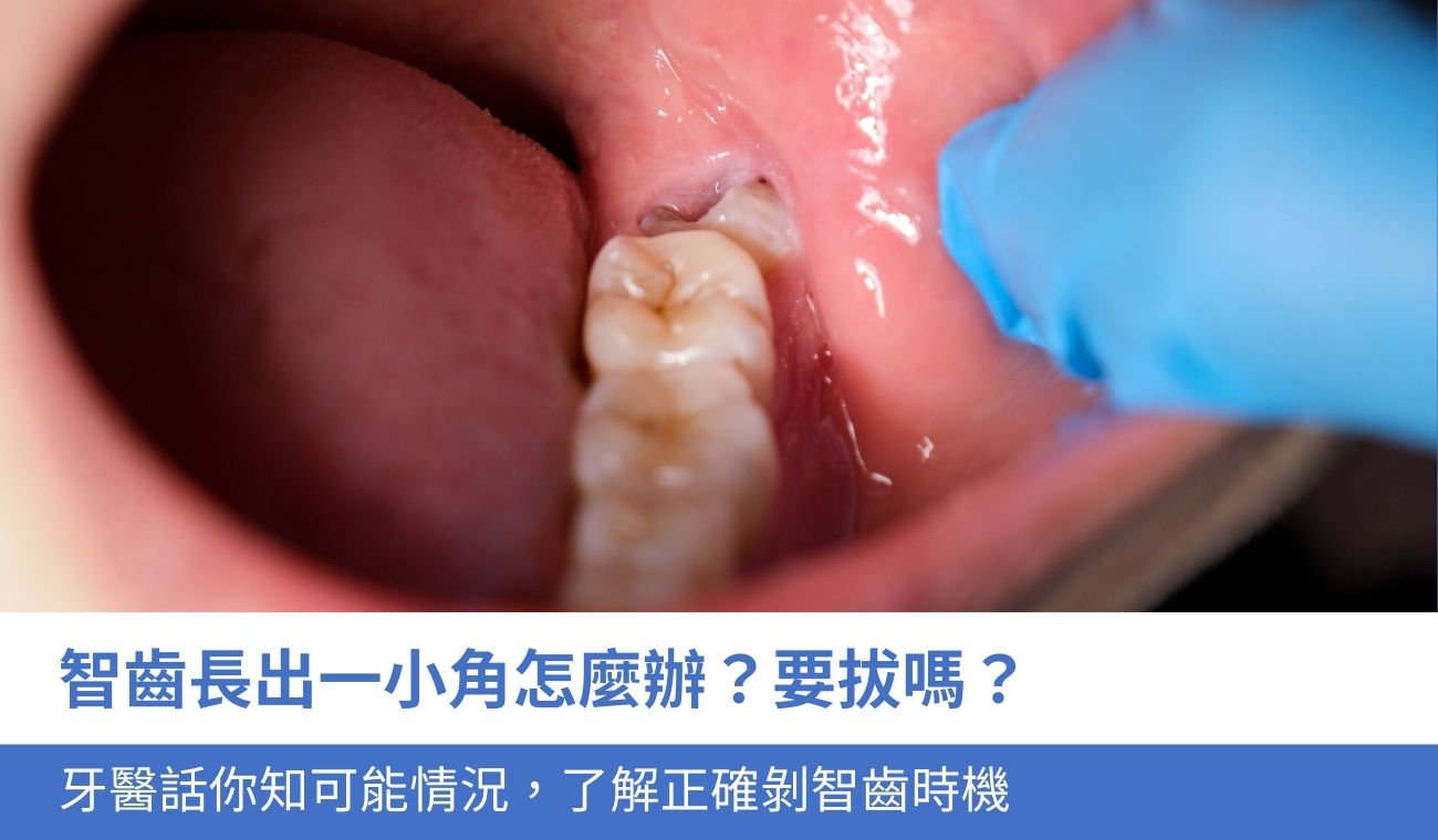 智齒長出一小角要拔嗎？一文看4種可能情況，了解正確剝智齒時機
