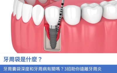 牙周袋是什麼？牙周囊袋深度和牙周病有關嗎？3招助你遠離牙周炎