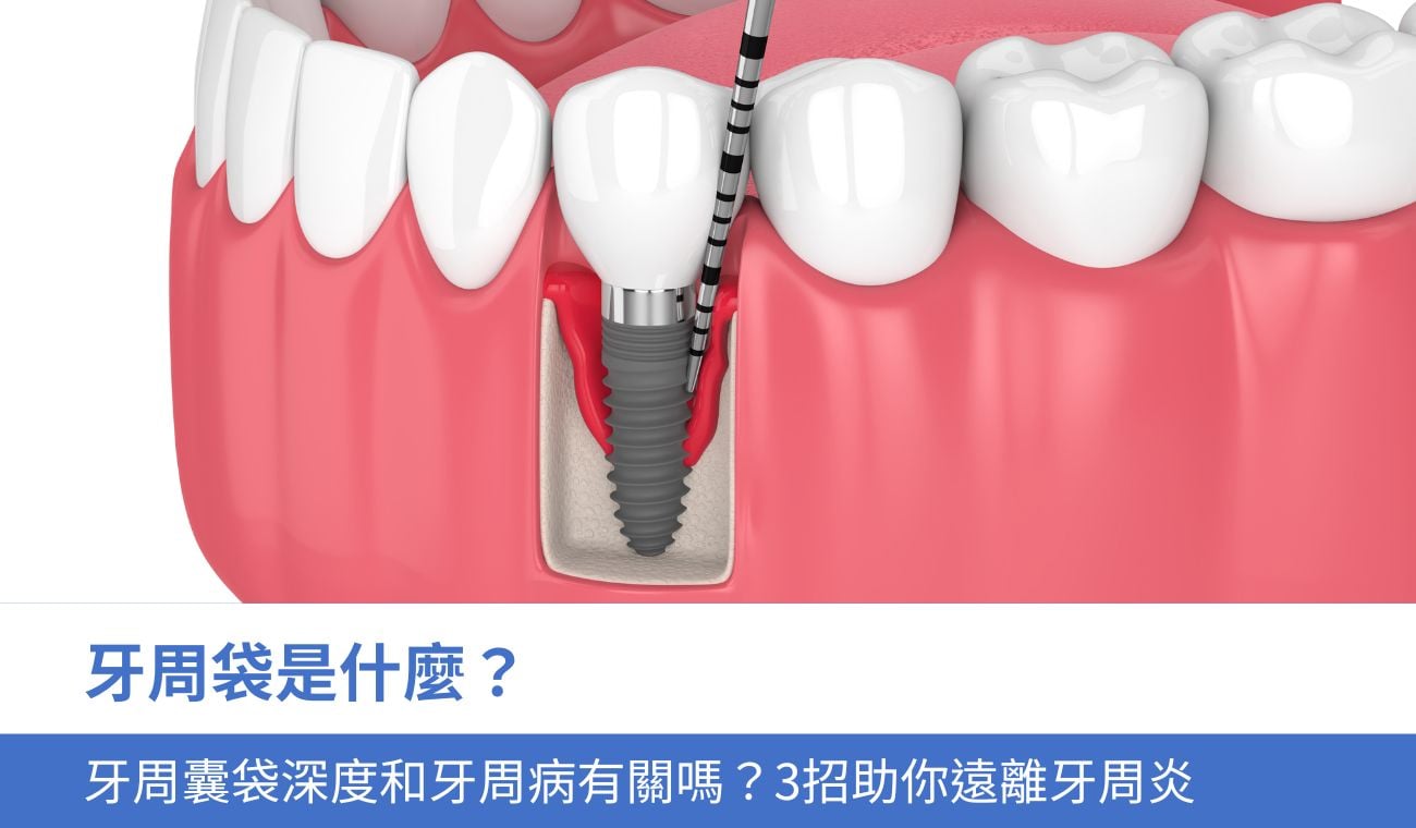 牙周袋是什麼？