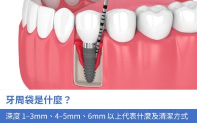 牙周袋是什麼?牙周囊袋深度 1–3mm、4–5mm、6mm 以上代表什麼及清潔方式