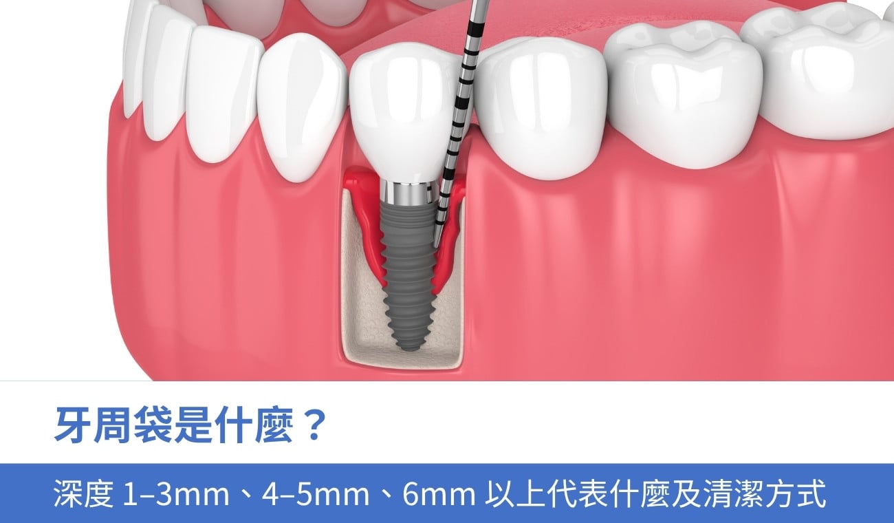 牙周袋是什麼？牙周囊袋深度 1–3mm、4–5mm、6mm 以上代表什麼及清潔方式