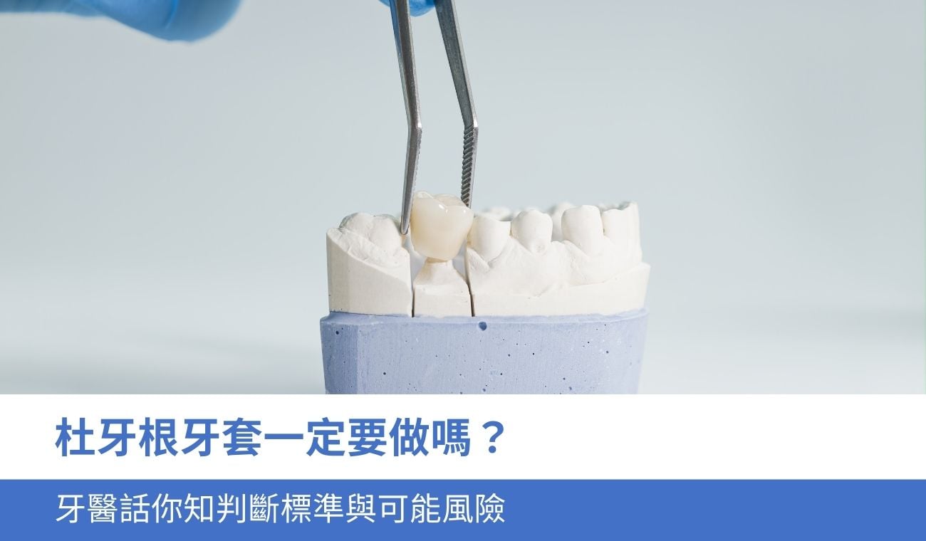 root-canal-dental-crown 杜牙根牙套一定要做嗎?牙醫話你知4大判斷標準與可能風險