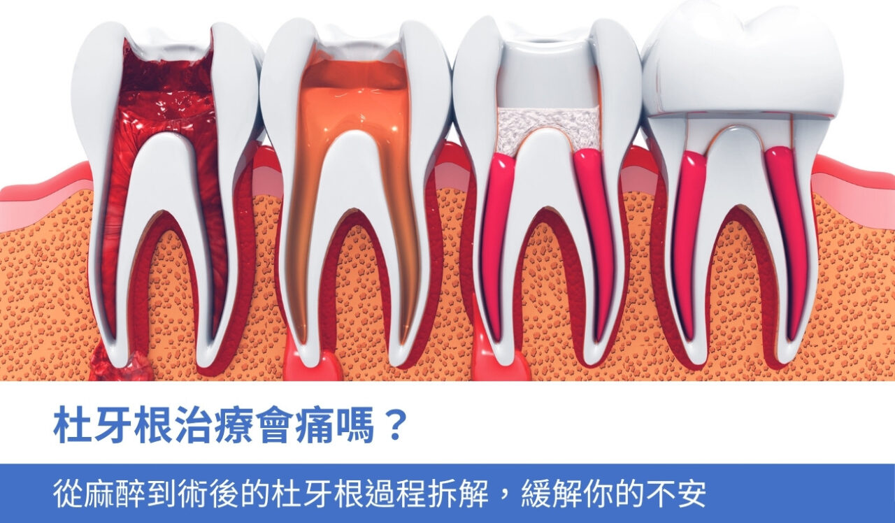 杜牙根治療會痛嗎？從麻醉到術後5個杜牙根過程拆解，緩解你的不安