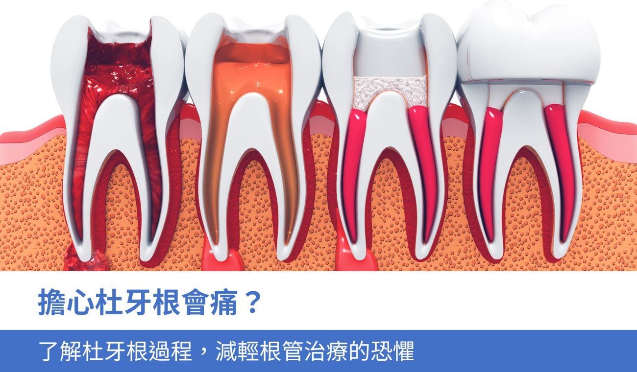 杜牙根痛嗎？了解杜牙根過程，減輕恐懼