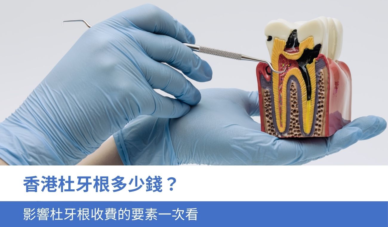 root-canal-treatment-cost 香港杜牙根多少錢?影響杜牙根收費的4大要素