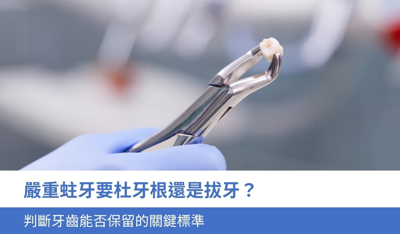 root-canal-vs-extraction 嚴重蛀牙要杜牙根還是拔牙?3個判斷牙齒能否保留的關鍵標準
