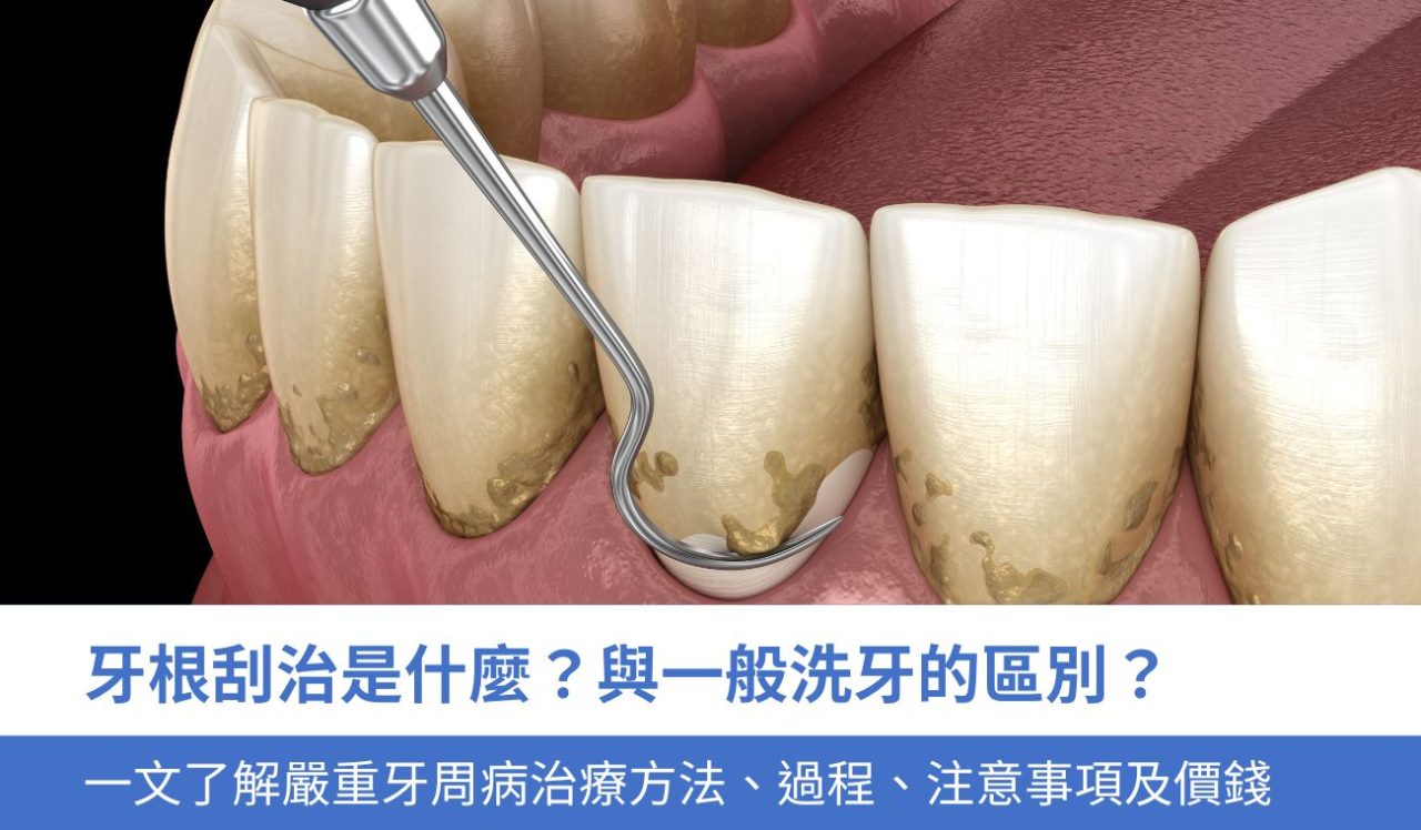 牙根刮治是什麼？與一般洗牙的區別？一文了解嚴重牙周病治療方法、過程、5大注意事項及價錢