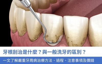 牙根刮治是什麼？與一般洗牙的區別？一文了解嚴重牙周病治療方法、過程、5大注意事項及價錢