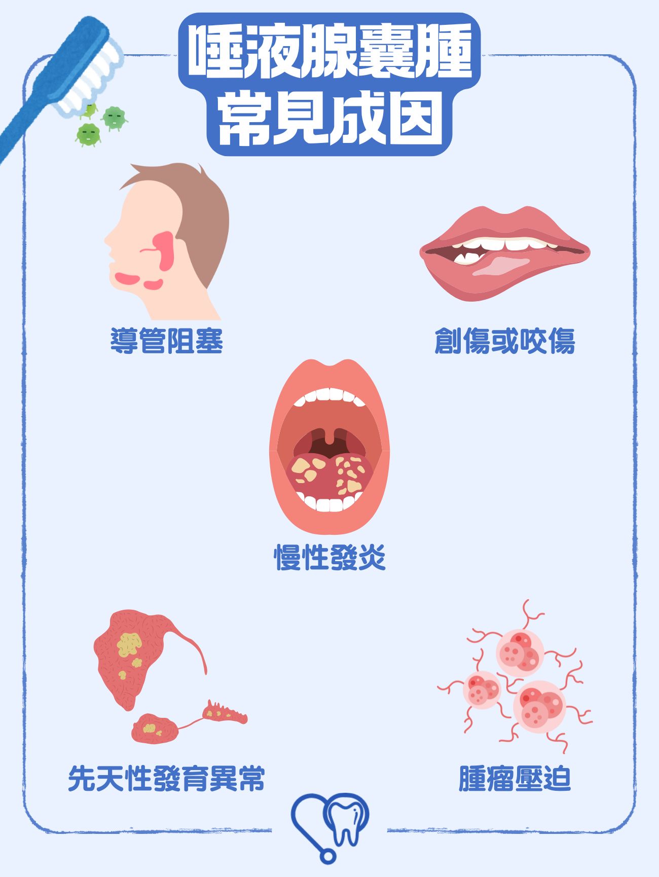 唾液腺囊腫常見成因