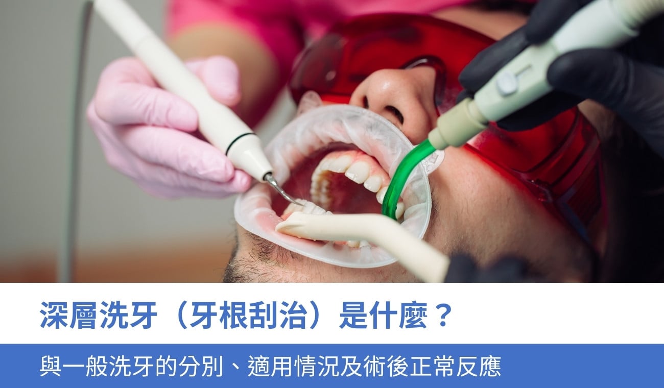 scaling-and-root-planing 深層洗牙(牙根刮治)是什麼?與一般洗牙的分別、適用情況及術後 3 種正常反應