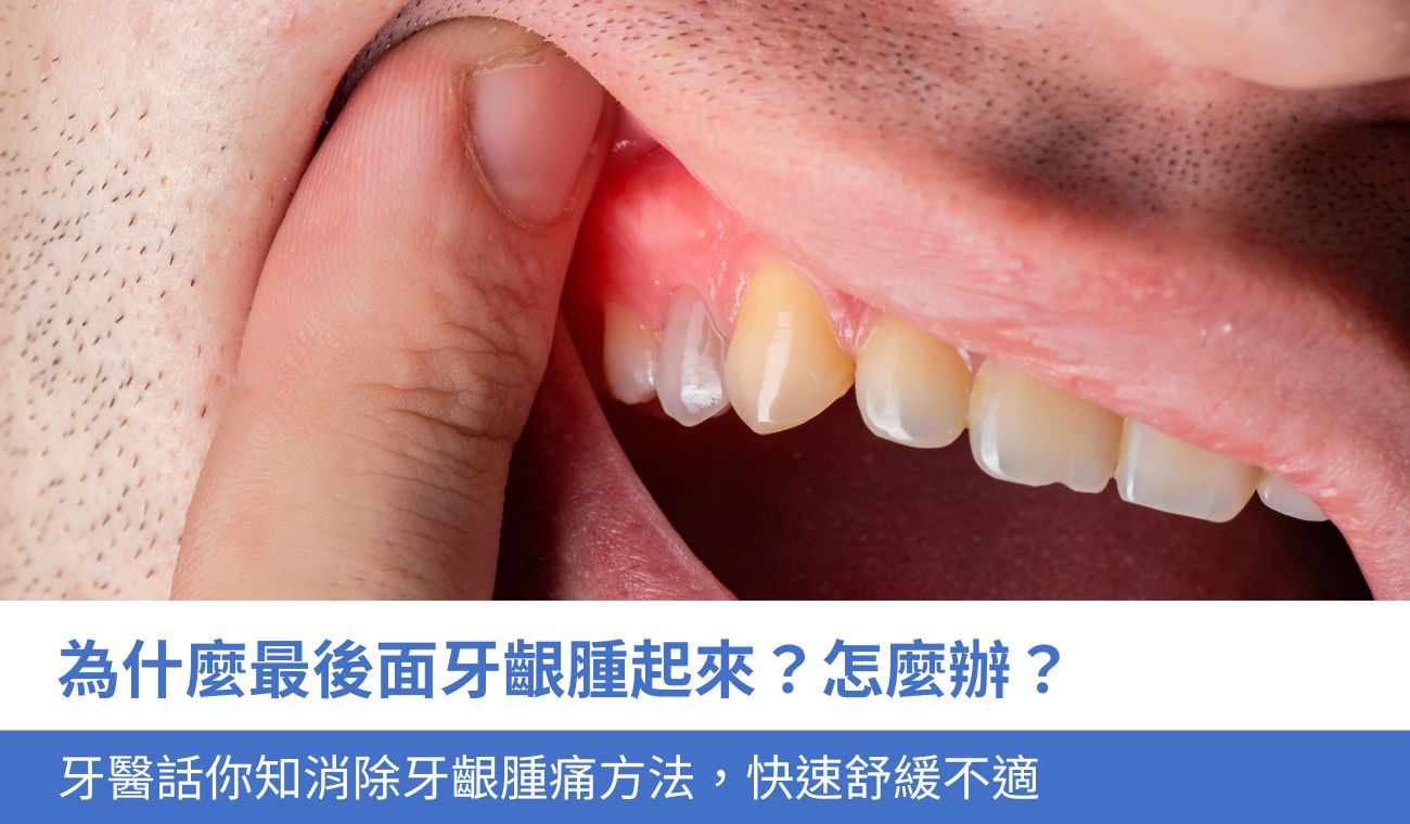 swollen-gums-at-back-mouth 最後面牙齦腫起來怎麼辦?牙醫話你知3大消除牙齦腫痛方法,快速舒緩不適