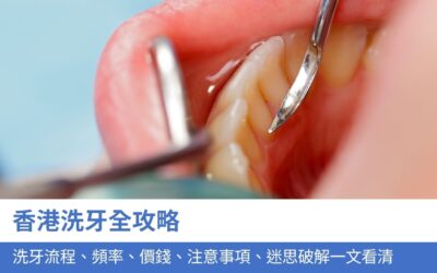 香港洗牙全攻略：洗牙流程、頻率、價錢、注意事項、迷思破解一文看清