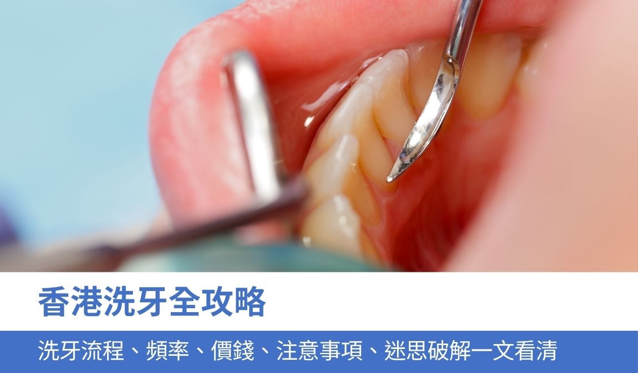 香港洗牙全攻略：洗牙流程、頻率、價錢、注意事項、迷思破解一文看清
