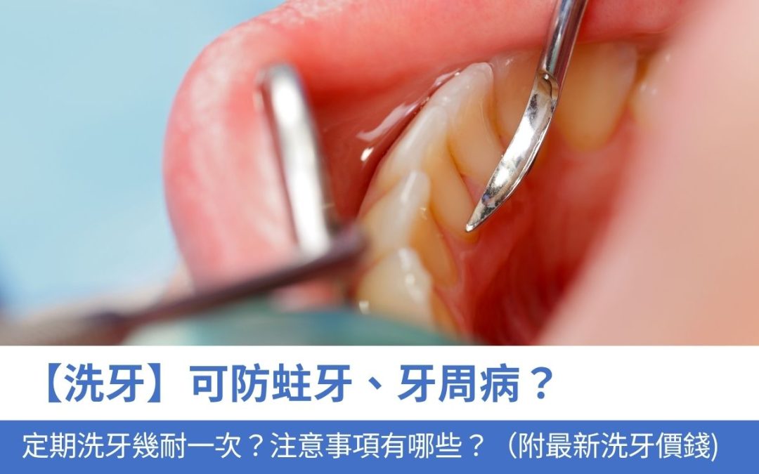 【洗牙】可防蛀 牙、牙周病？定期洗牙幾耐一次？注意事項有哪些？（附2025最新洗牙價錢＋完整流程）