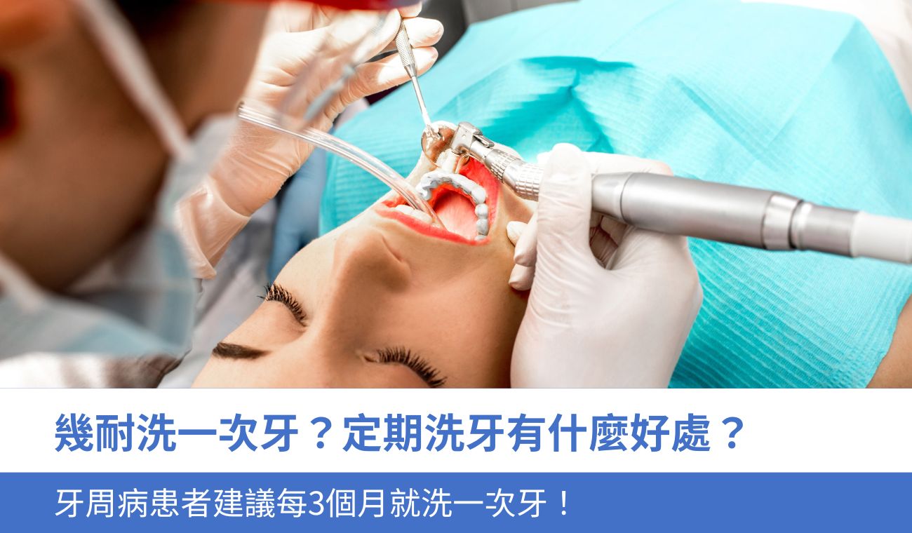 幾耐洗一次牙？定期洗牙有什麼好處？