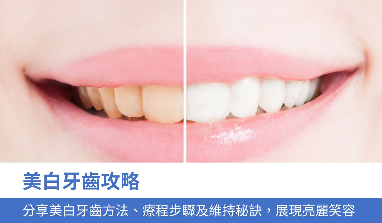 美白牙齒攻略：牙醫分享3大美白牙齒方法、療程步驟及維持秘訣，展現亮麗笑容