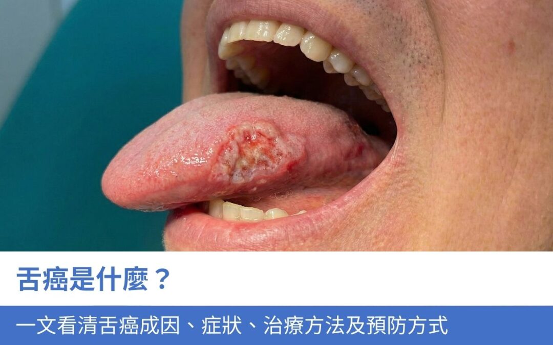 舌癌是什麼？一文看清舌癌成因、症狀、治療方法及 4 大預防方式
